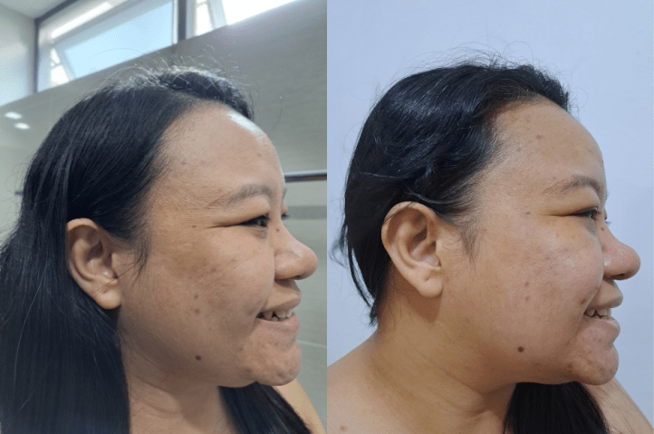 before and faster c02 fractional laser (1)