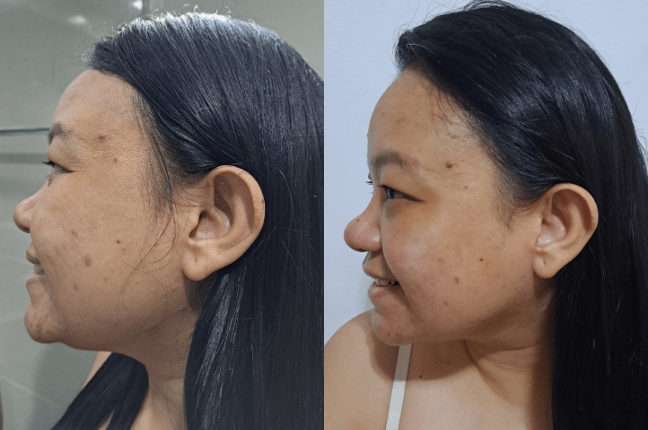 before and faster c02 fractional laser (2)