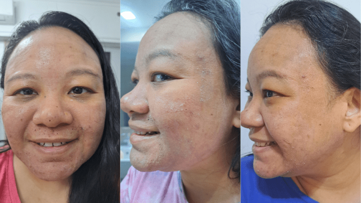 CO2 Fractional 12 hours after day 1 and day 3