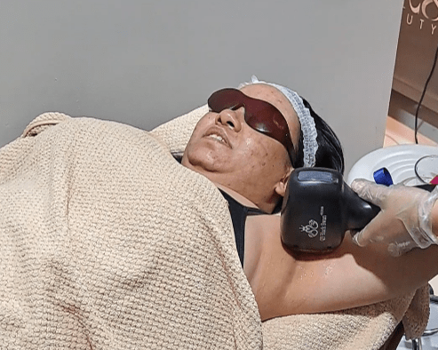 Diode Laser Hair Removal