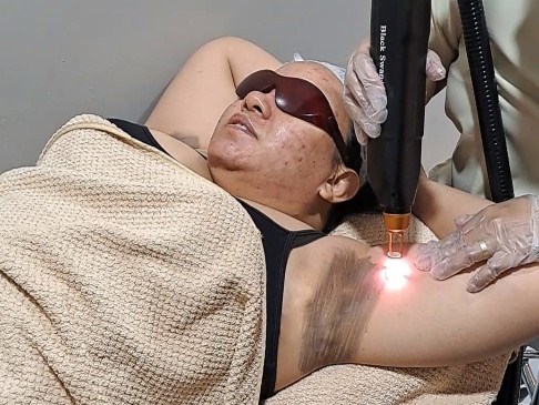 pico carbon laser treatment